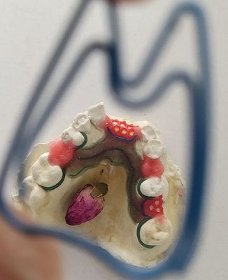 Рамки металла Denture Co Cr частично