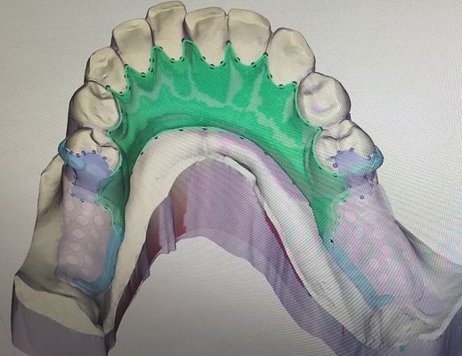 Съемное 3D напечатало частично рамки металла Denture