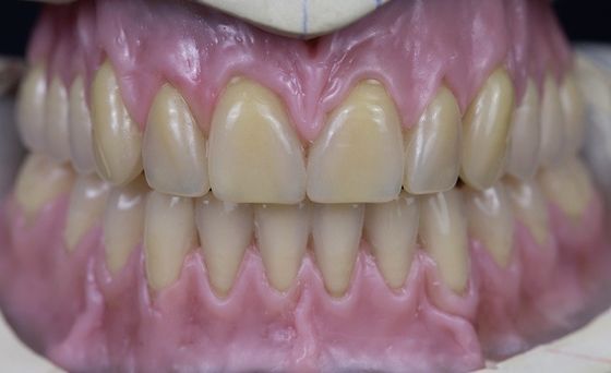 Горячий вылеченный Denture полного свода съемный акриловый полный