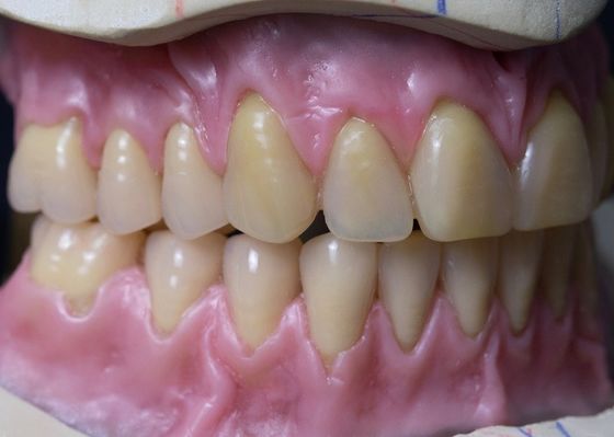 Горячий вылеченный Denture полного свода съемный акриловый полный