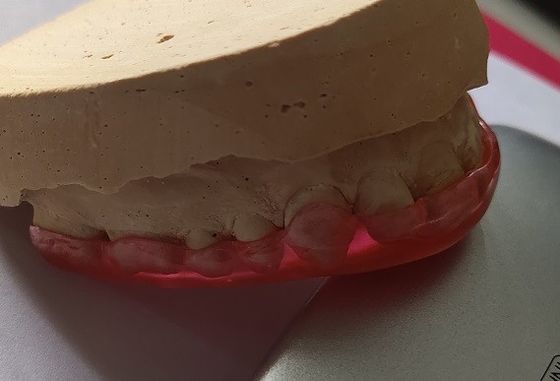 Трудный акриловый максиллярный предохранитель стабилизации свода для Bruxism