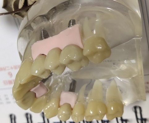100 крона Biocompatibility PMMA процентов временная