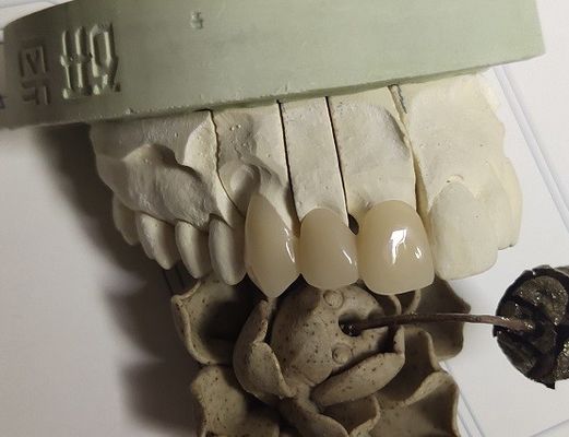 Крона метода ISO13485 CAD промежуточная