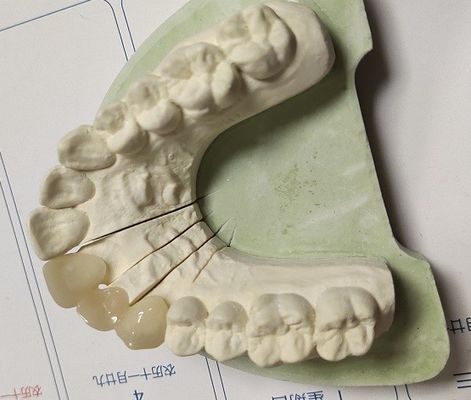 Крона метода ISO13485 CAD промежуточная