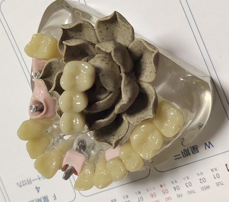 100 крона Biocompatibility PMMA процентов временная