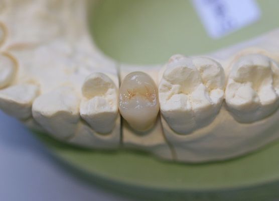 Кроны Aesthethics стеклянные керамические EMAX задние для моляров