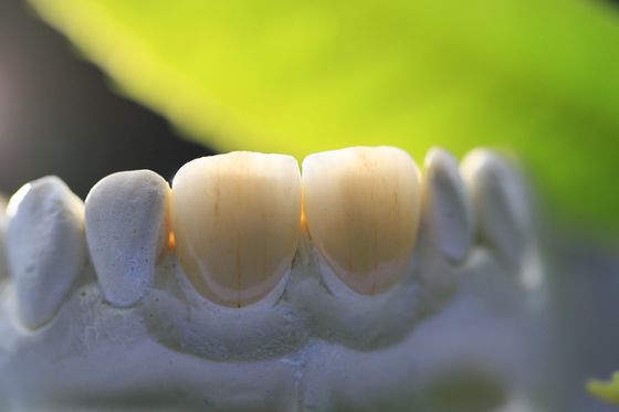 крона лаборатории рамок PFM печати 3D зубоврачебная для зубоврачевания