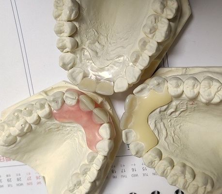 Denture металла смолы свободный невидимый для аллергического пациента